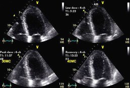 Dobutamine Stress Echo Image