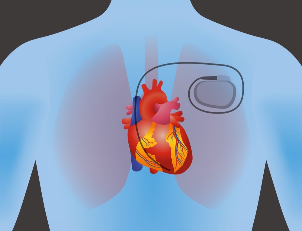 Pacemaker Image